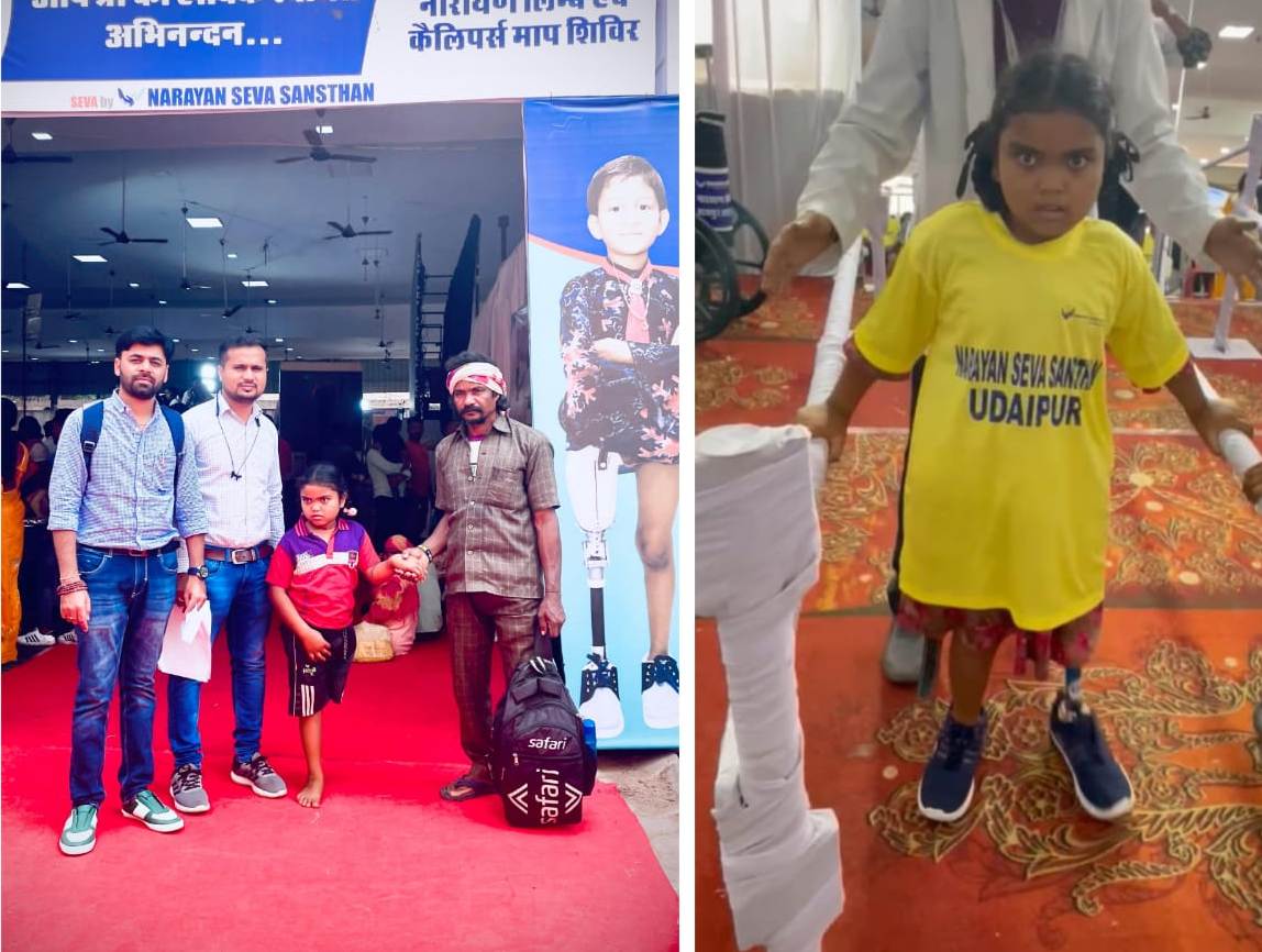 चिरायु योजना से संवर रहा है जीवन, नन्ही लक्ष्मी ने कृत्रिम पैरो के सहारे से चलना किया प्रारंभ