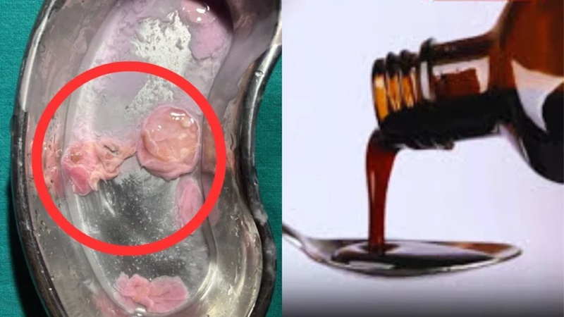 Meat in Syrup : गर्भवती महिला को दी गई सिरप में मिला मांस का टुकड़ा! राज्यपाल, CMO और DGP को पत्र लिखने के बाद FDA की जांच तेज...